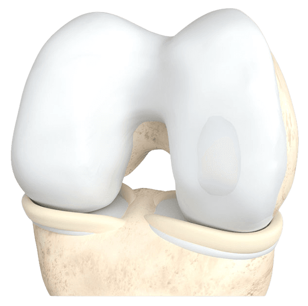 Illustration of a focal cartilage defect on the knee joint