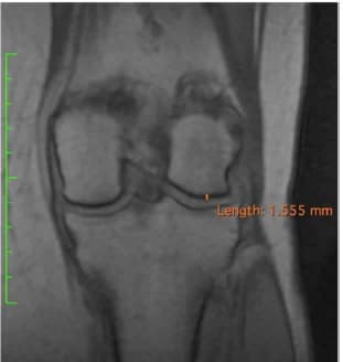 Coronal MRI at follow-up