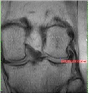 Sagittal MRI at follow-up