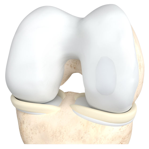 Advantages of ChondroFiller® Liquid