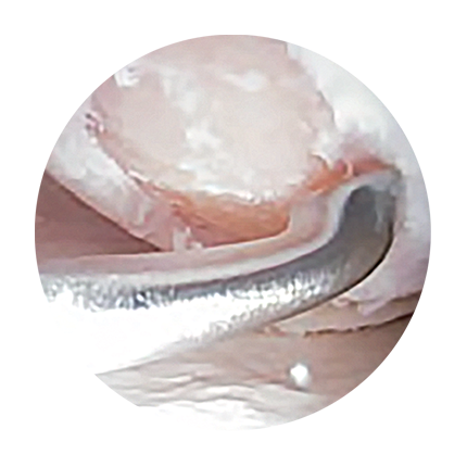 Cleaning of defect