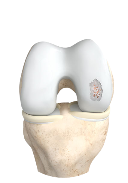 Cartilage damage, grade III–IV