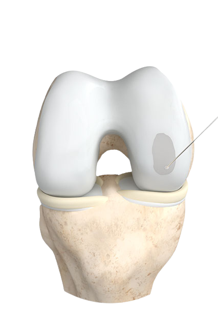 Filling of the defect with collagen 3D matrix