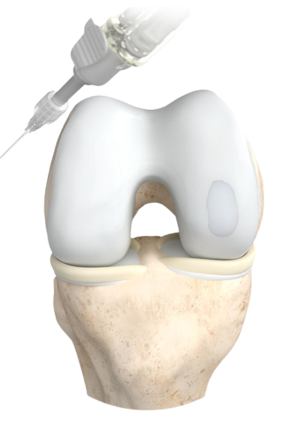 Formation of stable regenerated cartilage matrix